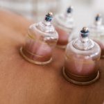 What Is Cupping Therapy and Does It Work